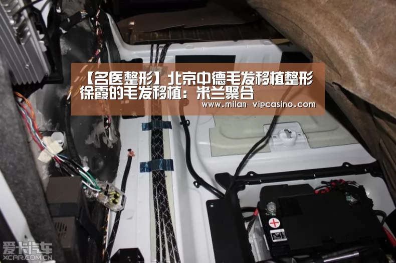 【名医整形】北京中德毛发移植整形徐霞的毛发移植:米兰聚合(图4) 米兰APP